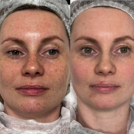 Фотоомоложение на аппарате Estetica 3.0